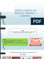 Lesión Cariosa en Esmalte, Dentina y Cemento