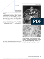 Neuro Images: Sixth Nerve Palsy in Nasopharyngeal Carcinoma