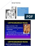 Paraduodenal hernia and Solid Pseudopapillary Tumor