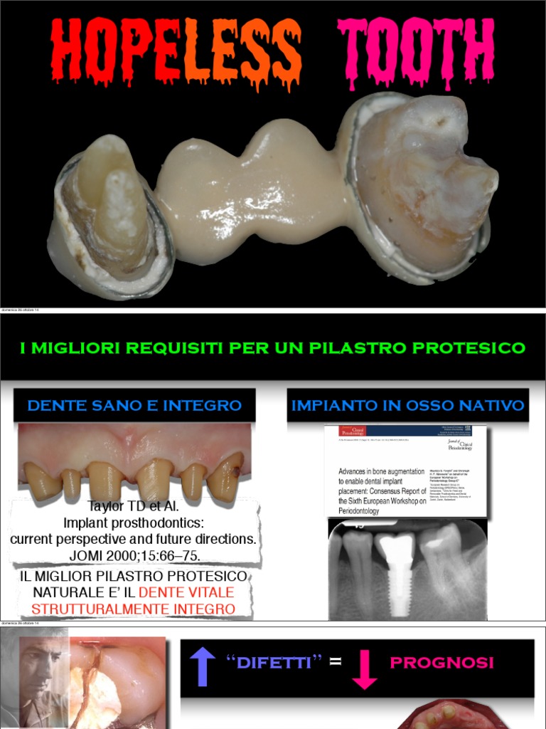 Estratto Hopeless Tooth | Download Free PDF | Dental Implant | Facial ...