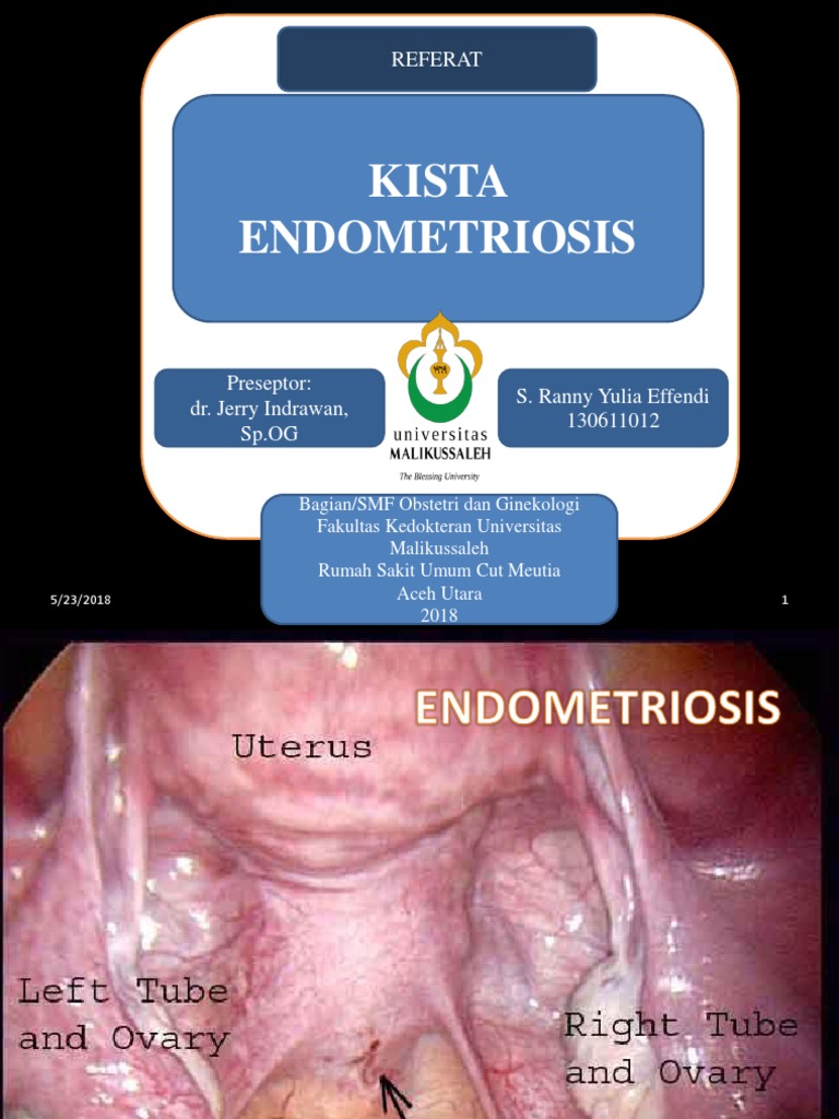 Kista endometriosis