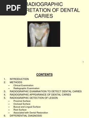 Radiographic Interpretation of Dental Caries - Dental eBook & Lecture Notes PDF Download (Studynama.com - India's Biggest Website for BDS Study Material Downloads)