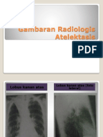 359371848-Atelektasis-Dan-Bronchiectasis.pptx