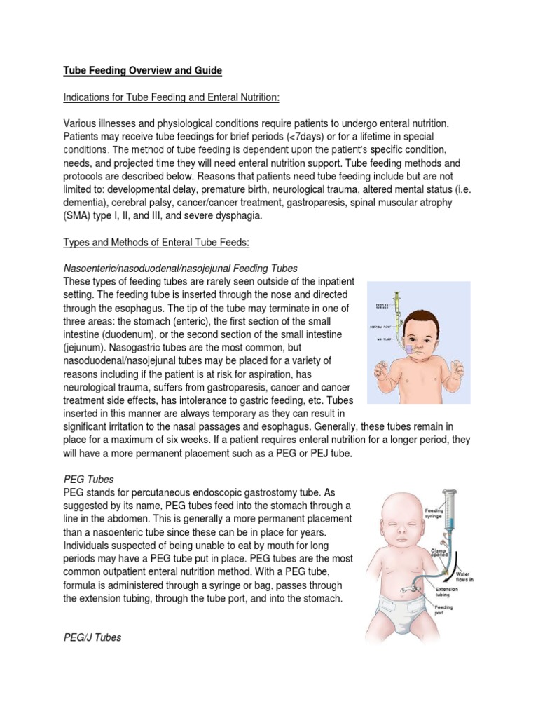 Tube Feeding Overview and Guide Nasoenteric/nasoduodenal/nasojejunal