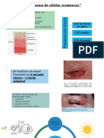 Carcinoma de Celulas Escamosas en Parpado