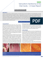 Verruciform Xanthoma of The Orall Cavity