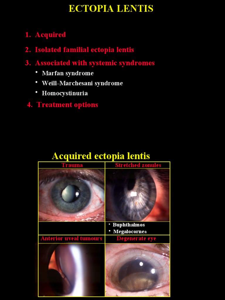Acquired 2. Isolated Familial Ectopia Lentis 3. Associated With ...