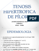 Estenosis Hipertrofica de Píloro