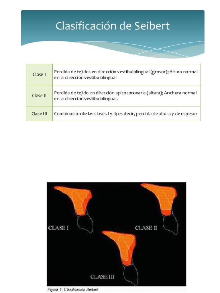 Clasificaciones de Reabsorcion en Procesos Alveolares | PDF