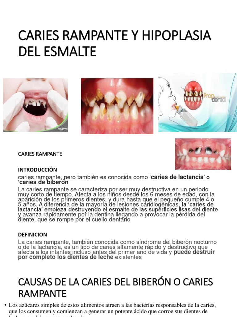 Carier Rampante | PDF | Diente | Esmalte de dientes