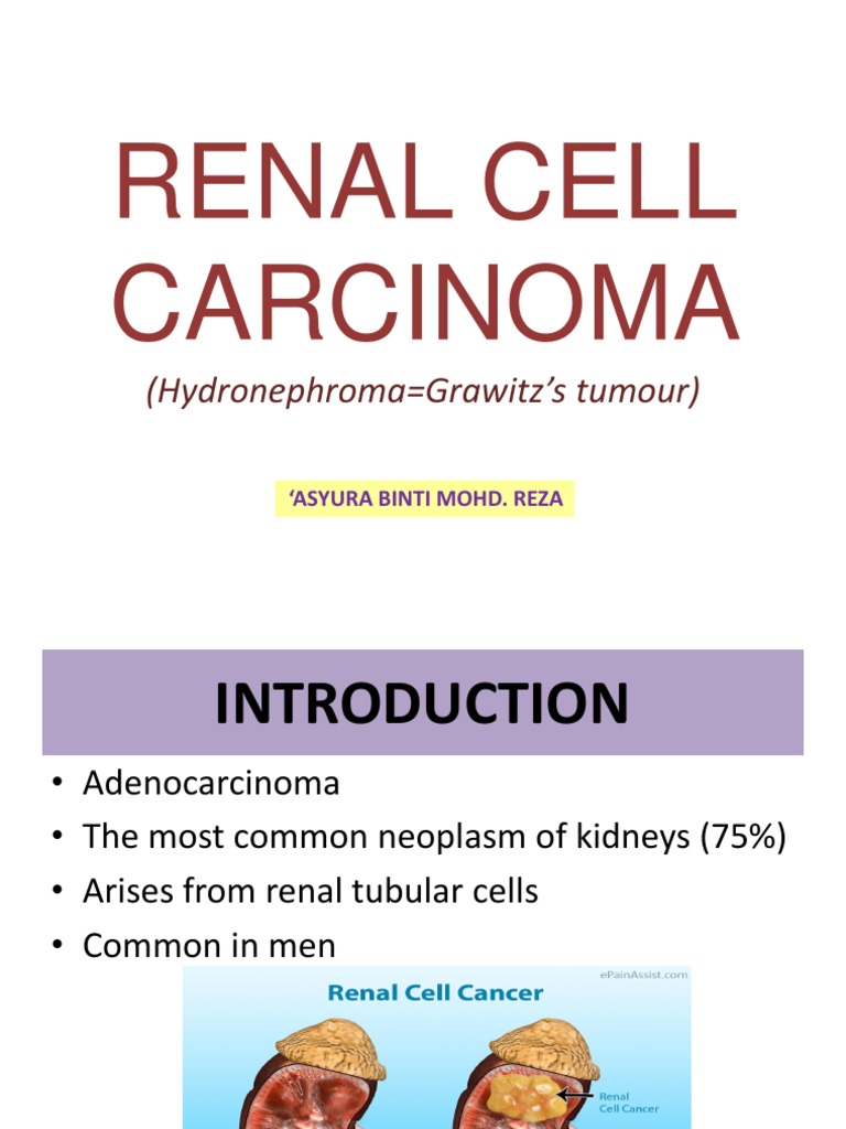 renal-cell-carcinoma-pdf-anatomy-neoplasms