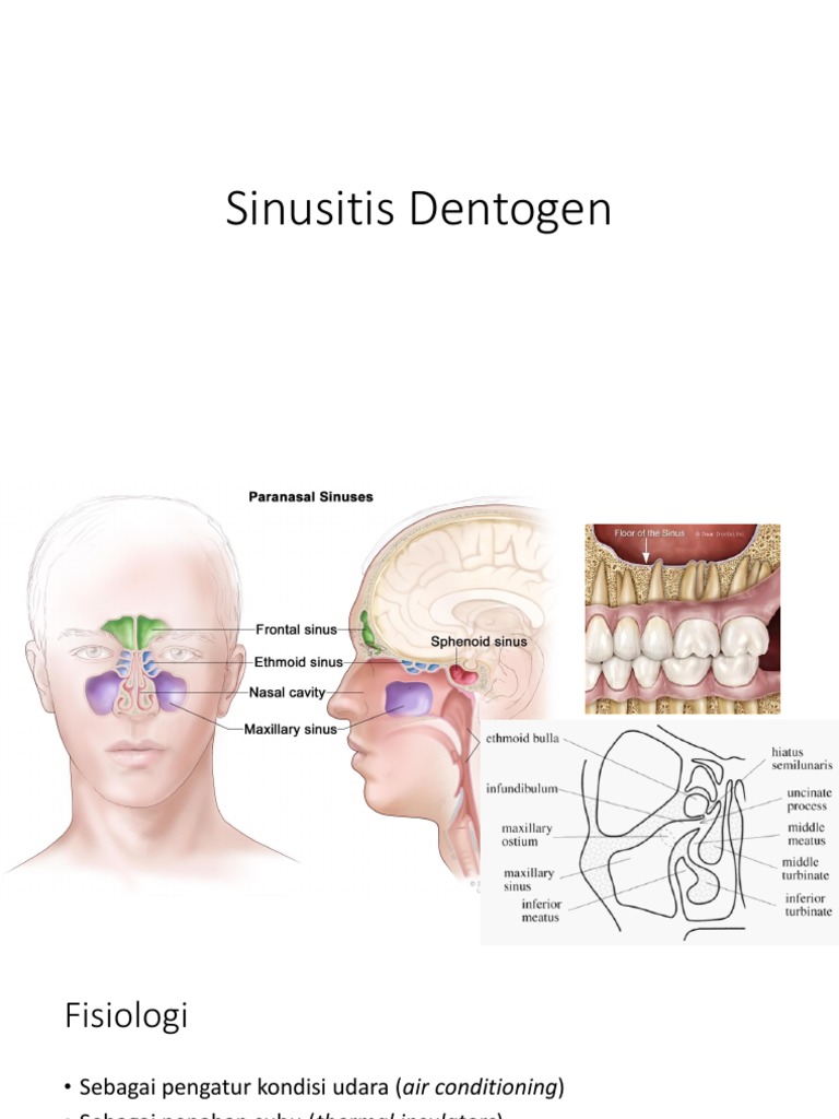 Sinusitis Dentogen | PDF | Sains & Matematika