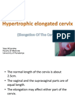 Hypertrophic Elongated Cervix (Elongation of Cervix)