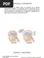 hidrocefalia-por-estenosis-del-acueducto-de-silvio-pdf-enfermedades