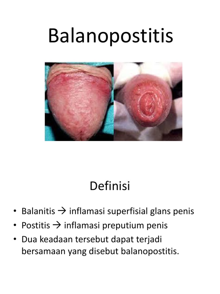 Balanopostitis: Definisi dan Tatalaksana | PDF