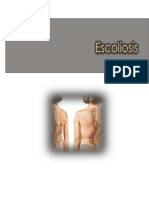 e Scoliosis