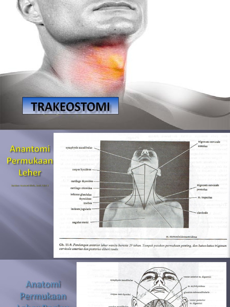 TRAKEOSTOMI Bahan Presentasi Hi-5 | PDF | Sains & Matematika