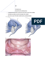 Mandibular Vestibuloplasty