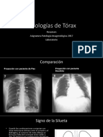 Patologías de Tórax: Neumonía, Tuberculosis, Enfisema y más