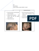 Psoriasis Vs Seboroik