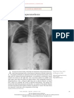 Hydropneumothorax: Images in Clinical Medicine