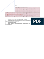 Contoh Gambar EKG Atrial Fibrilasi