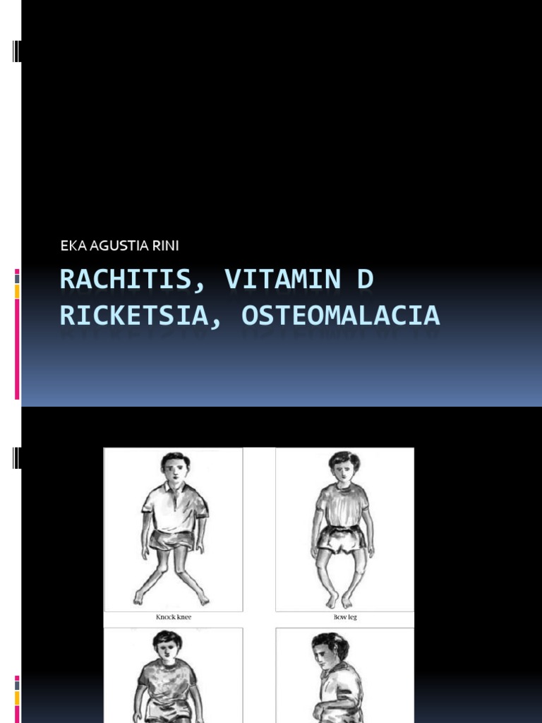 Understanding Rickets and Osteomalacia | PDF | Vitamin D | Wellness