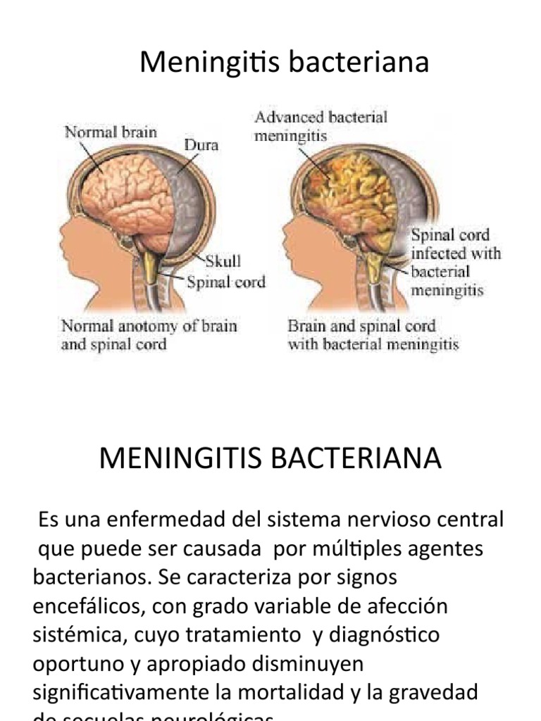 Meningitis Bacteriana
