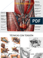 Plastias Inguinales Laminas PDF