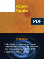 Agujero Macular