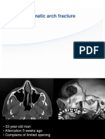 Case 1: Zygomatic Arch Fracture