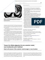 Tumor de Ce Lulas Gigantes de Arco Anterior Costal, Una Localizacio N Poco Habitual