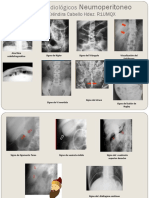 Signos Radiológicos Neumoperitoneo