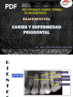 Clasificación Radiográfica de Caries de Pitts | PDF