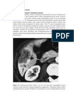 Cholangicarcinoma (CT Scan)
