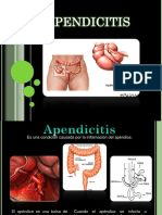 La apendicitis: causas, síntomas y tratamiento quirúrgico