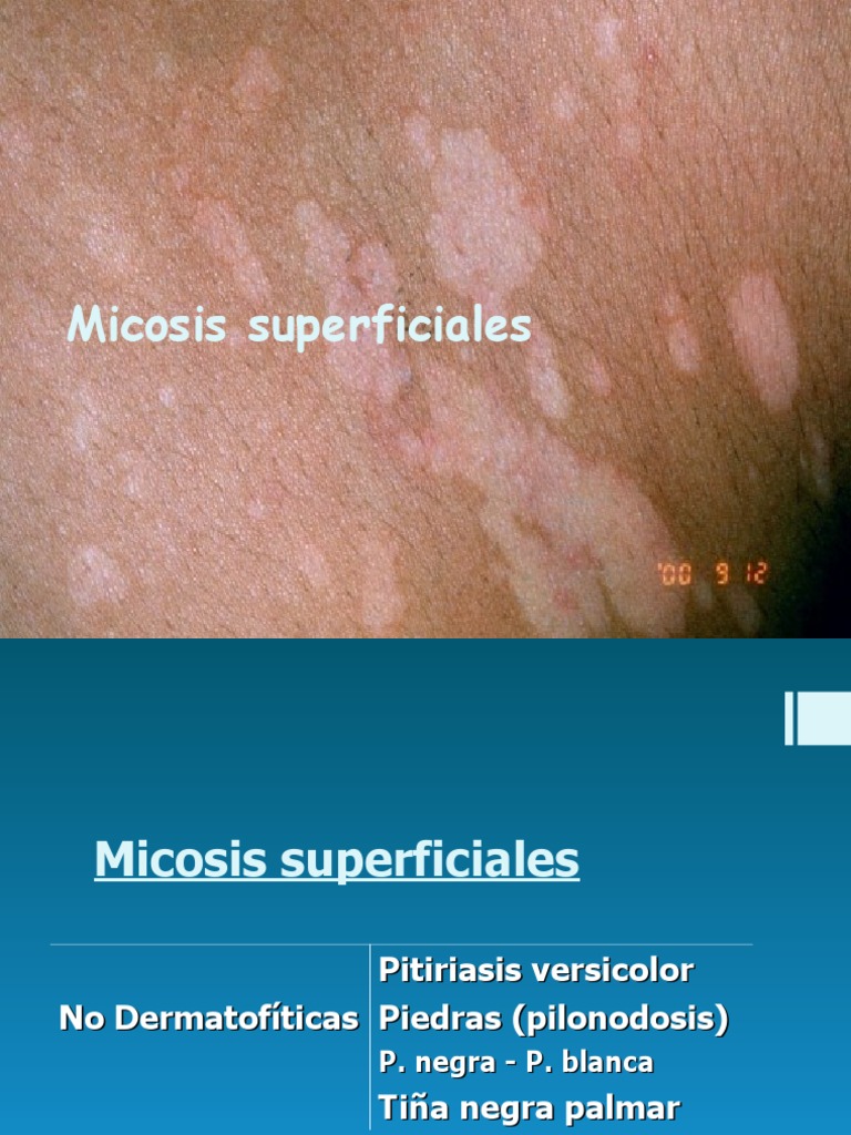 micosis-superficiales-pdf-piel-enfermedades-y-trastornos