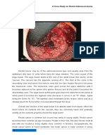A Case Study on Rectal Adenocarcinoma