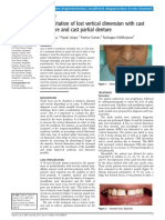 Rehabilitation of lost vertical dimension with cast post core and cast partial denture