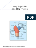 Neglected Hip Fractures