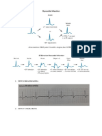 Ekg Angina