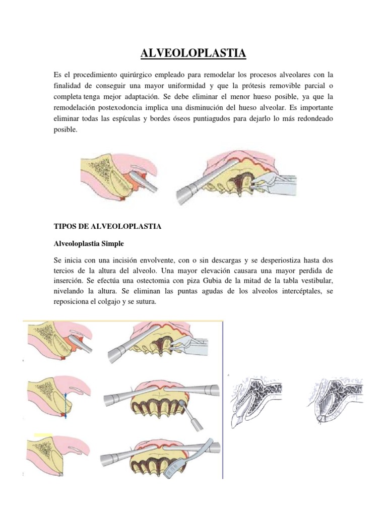 248868910-ALVEOLOPLASTIA.docx