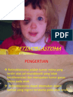 Retinoblastoma