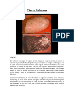 Cáncer Pulmonar