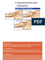 Posterior Glenohumeral Joint Dislocation