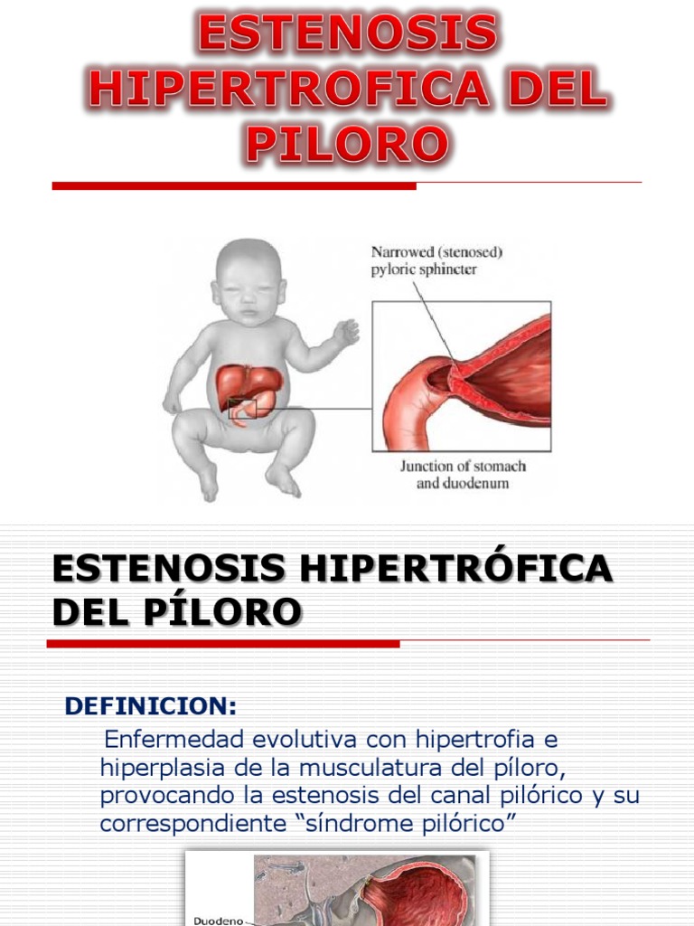 Estenosis Pilorica | PDF | Estómago | Cirugía