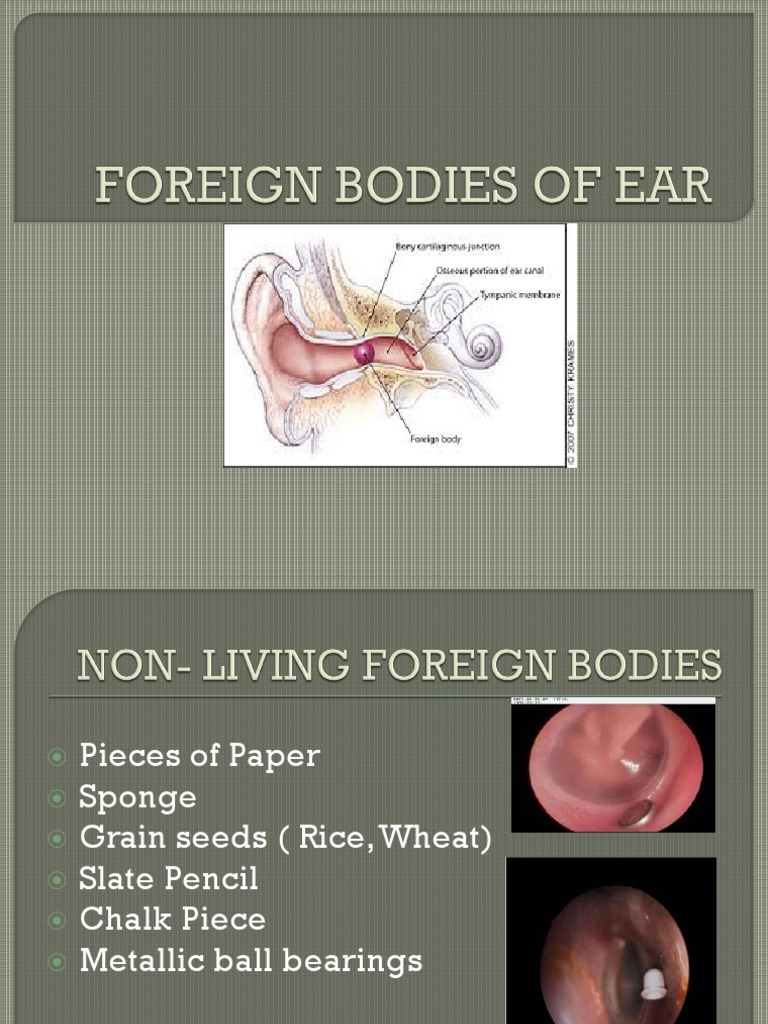 Ear Infections and Foreign Body Removal | PDF