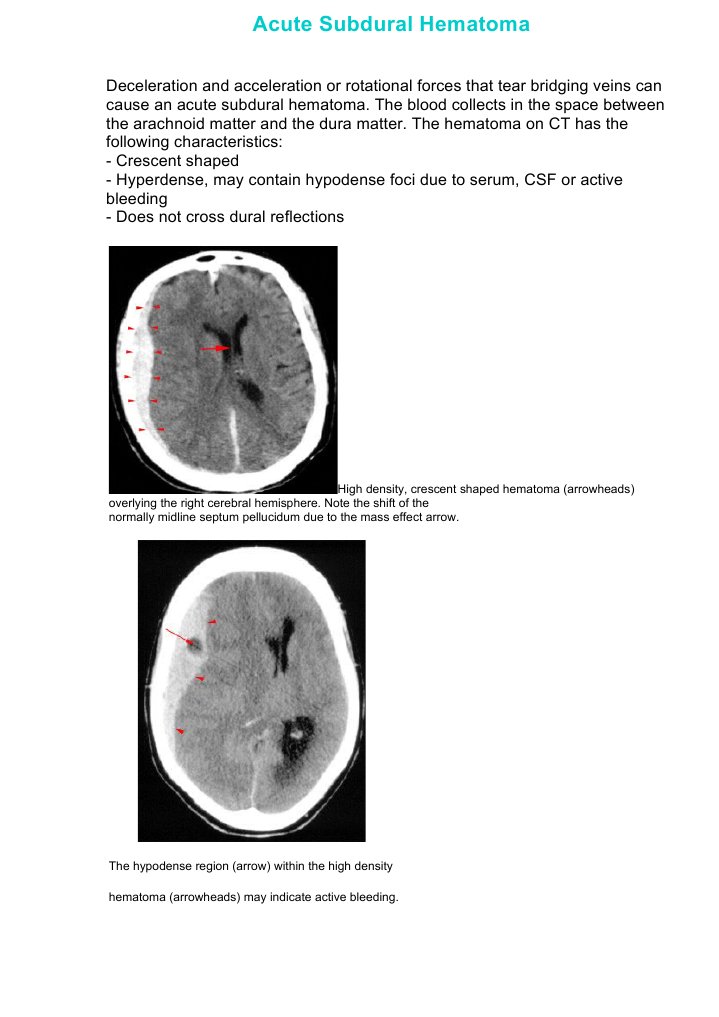 Acute Subdural Hematoma | PDF