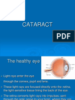 Cataract