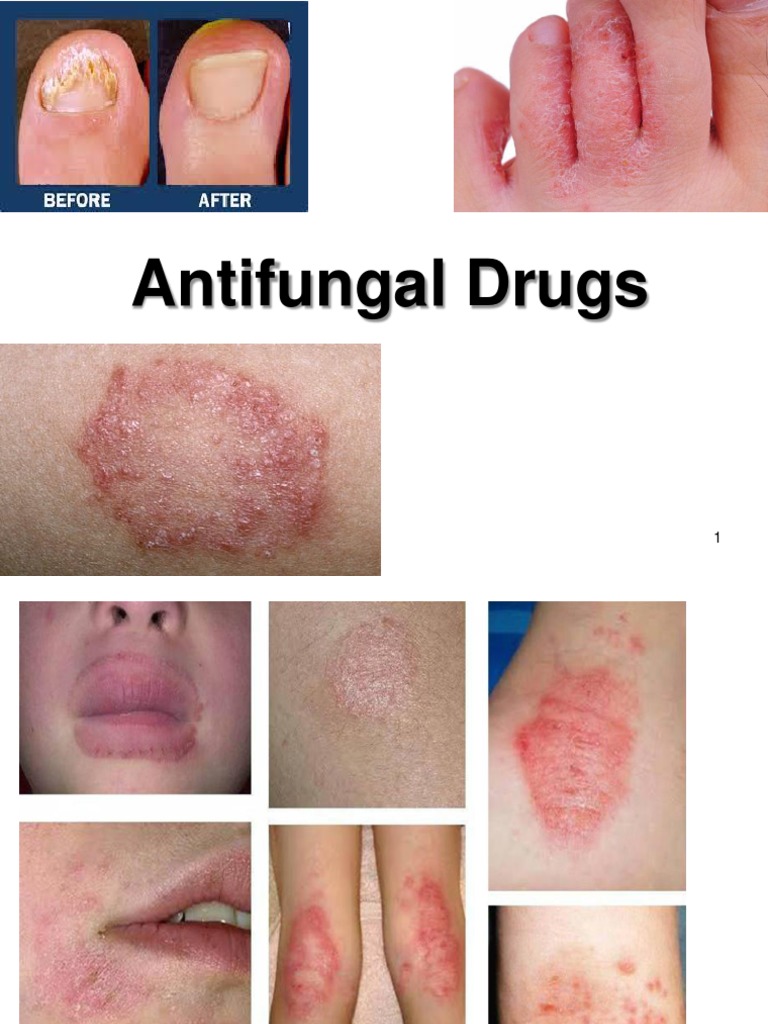 Antifungals PDF Candidiasis Fungus